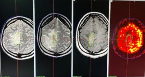 15th Anniversary Of Gamma Knife