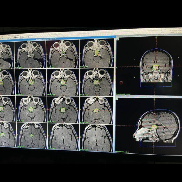 Case Report Pituitary Adenoma