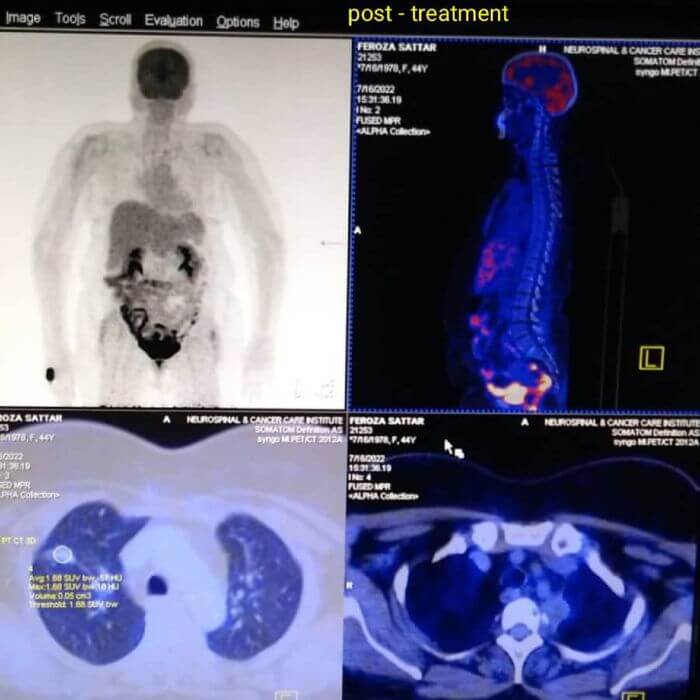 High Precision Of PET-CT Scan at NCCI
