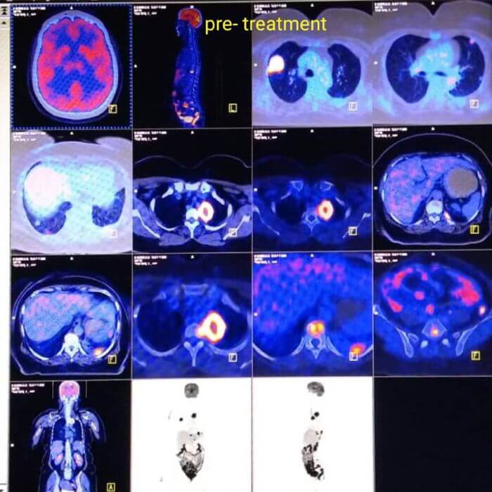 High Precision Of PET-CT Scan