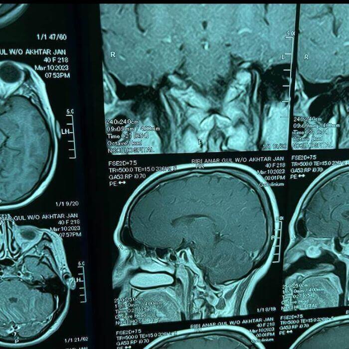 gamma knife radiosurgery at NCCI