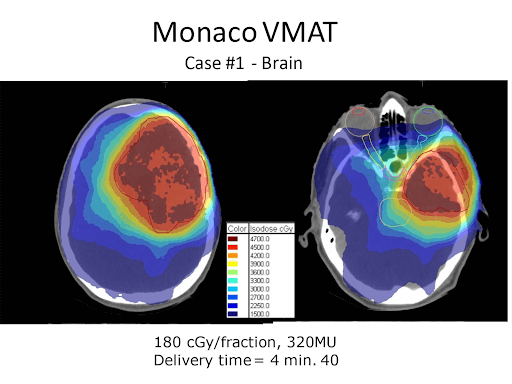 Monaco VMAT Case 1